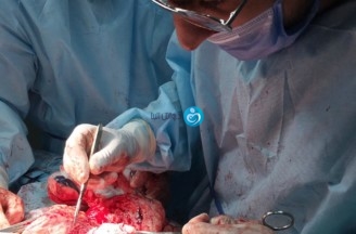 Think twice before doing open surgery or laparoscopic drilling for chocolate cysts
