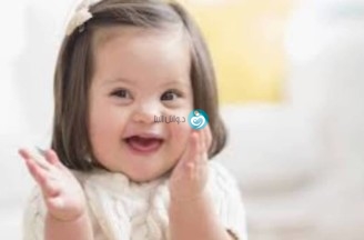 (Down Syndrome) متلازمة داون