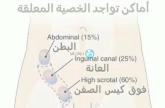 الخصية المعلقة