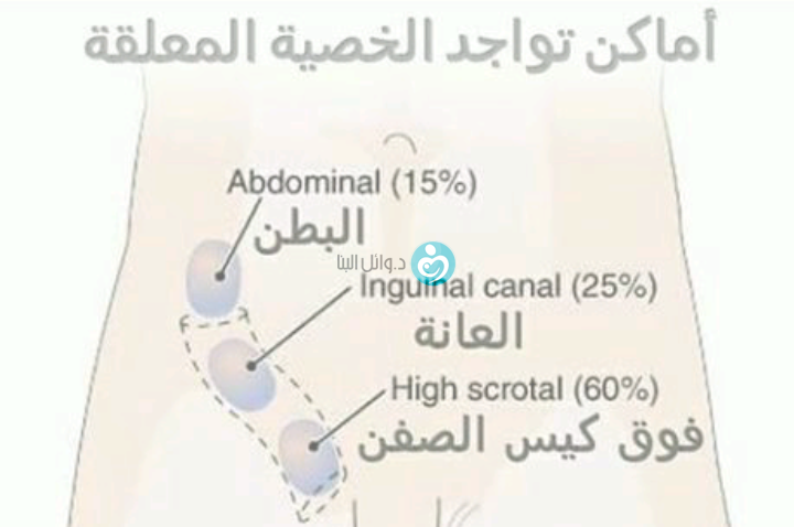 الخصية المعلقة عند الكبار وكيفية العلاج