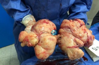 Removing her womb was her daily nightmares, finally 28 cm fibroid removed successfully with womb preservation !!!