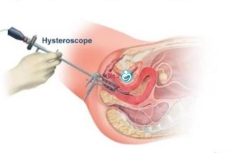 إجراء منظار رحمي