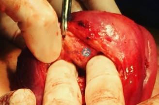 To keep her virginity asked to open her tummy instead of minimal invasive surgery from below