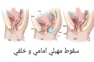 إصلاح السقوط المهبلي