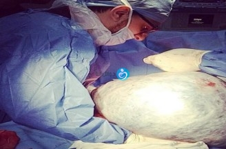 Thank God,18 Kg Ovarian Mass has been removed Successfully
