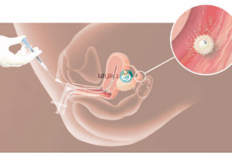 what is Intra Uterine Insemination IUI