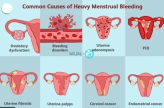 Causes of Heavy Menstrual Bleeding