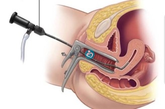Treatments for heavy or prolonged menstrual bleeding