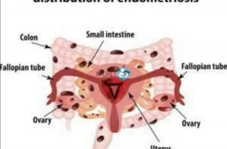 Endometriosis