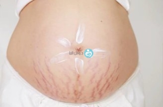 Stretch marks with pregnancy