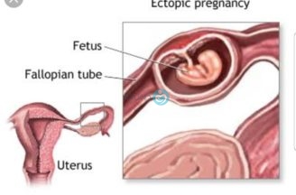الحمل خارج الرحم “الحمل من مكان غير معروف”