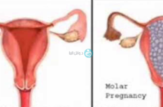 Who is affected by molar pregnancy
