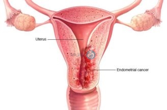 Womb (uterus) cancer