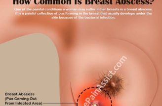 Breast abscess