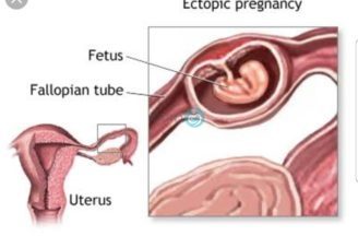 Ectopic pregnancy ” pregnancy of unknown location “