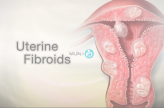 How do fibroids cause infertility