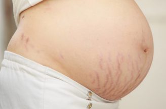 Stretch marks in pregnancy