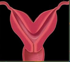 Bicornuate Uterus