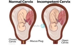 Cervical Incompetence