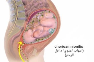 Intrauterine infection (chorioamnionitis)
