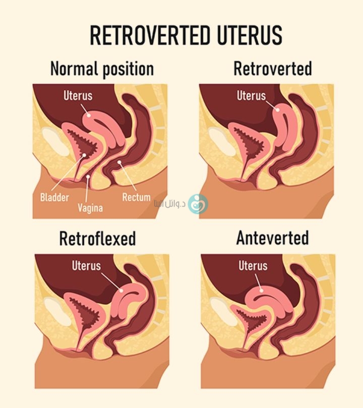 Is it possible to get pregnant with a retroverted uterus?