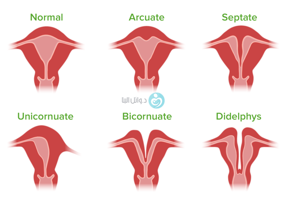 congenital-uterine-anomalies-dr-wael-elbanna