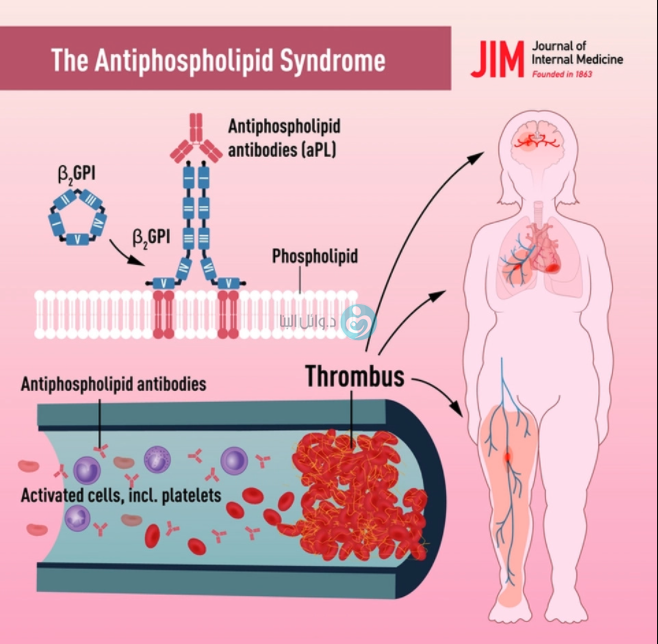 Antiphospholipid syndrome Dr. Wael Elbanna