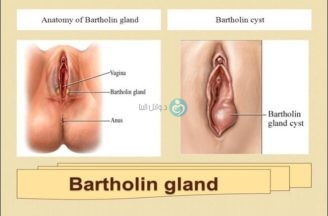 Bartholin cyst