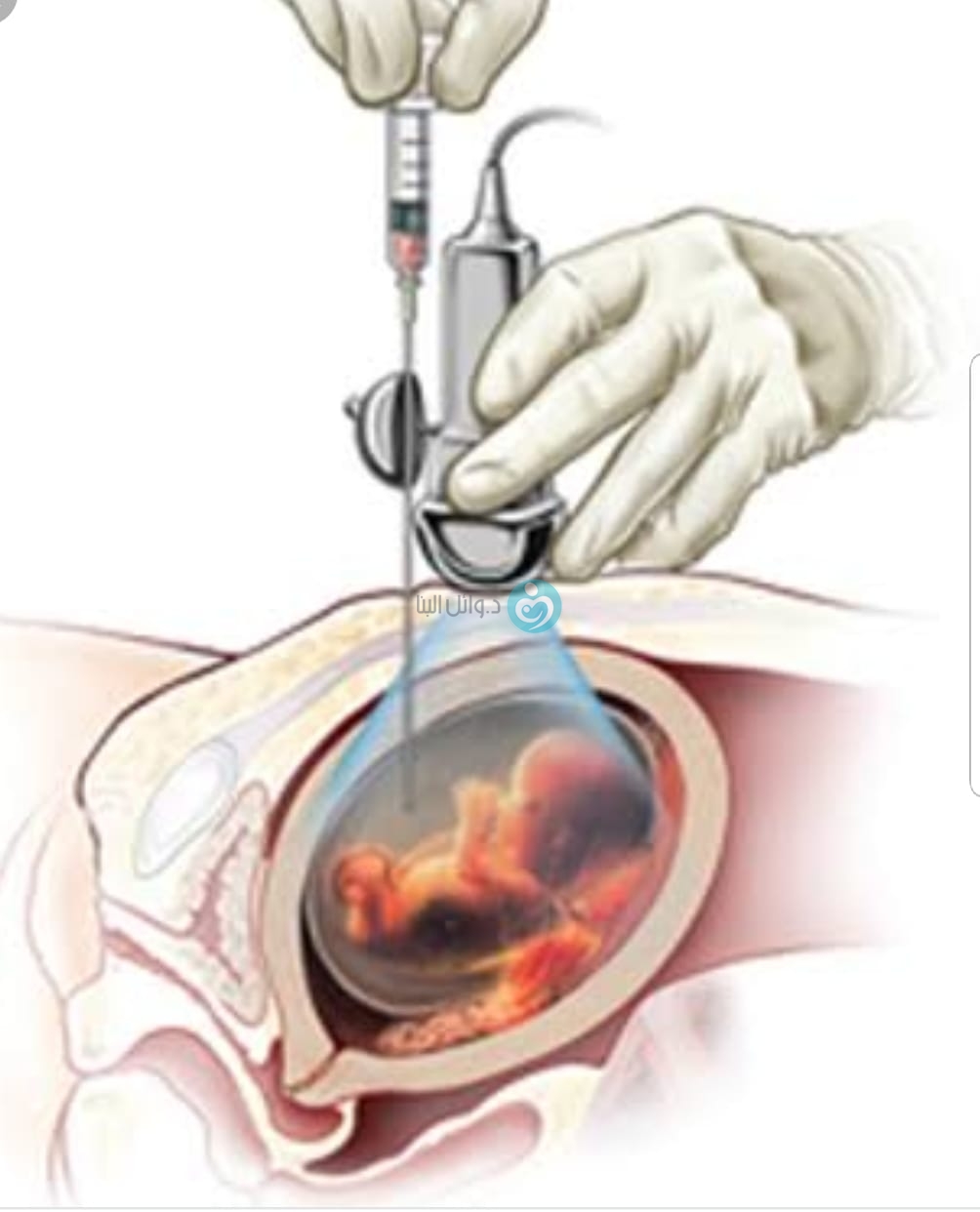 chorionic villus sampling(CVS) - Dr. Wael Elbanna - د. وائل البنا
